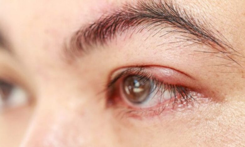 8 pendorong mata bintitan kemudian cara mengatasinya secara alami